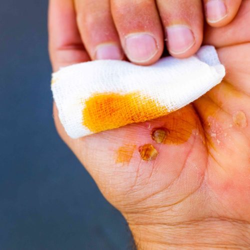 application-of-iodine-to-clean-wounds-in-the-palm application-of-iodine-to-clean-wounds-in-the-palm